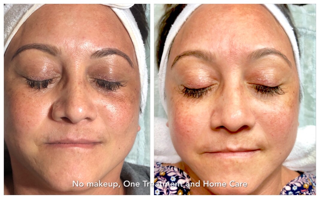 Skin Care Transformations